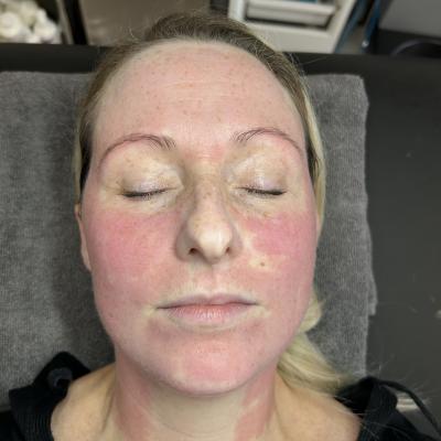 Microneedling 202300003